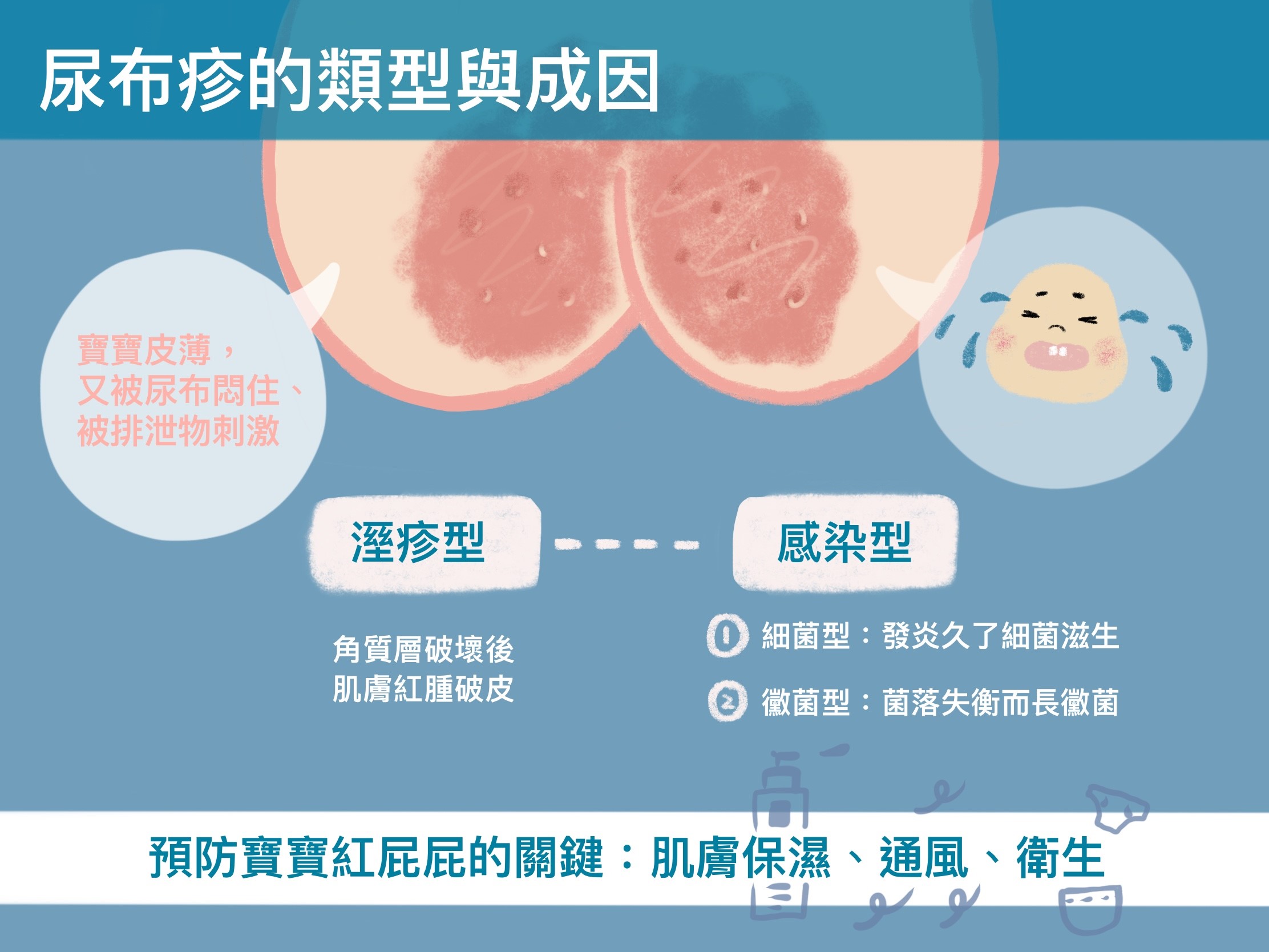 尿布疹的類型與成因
