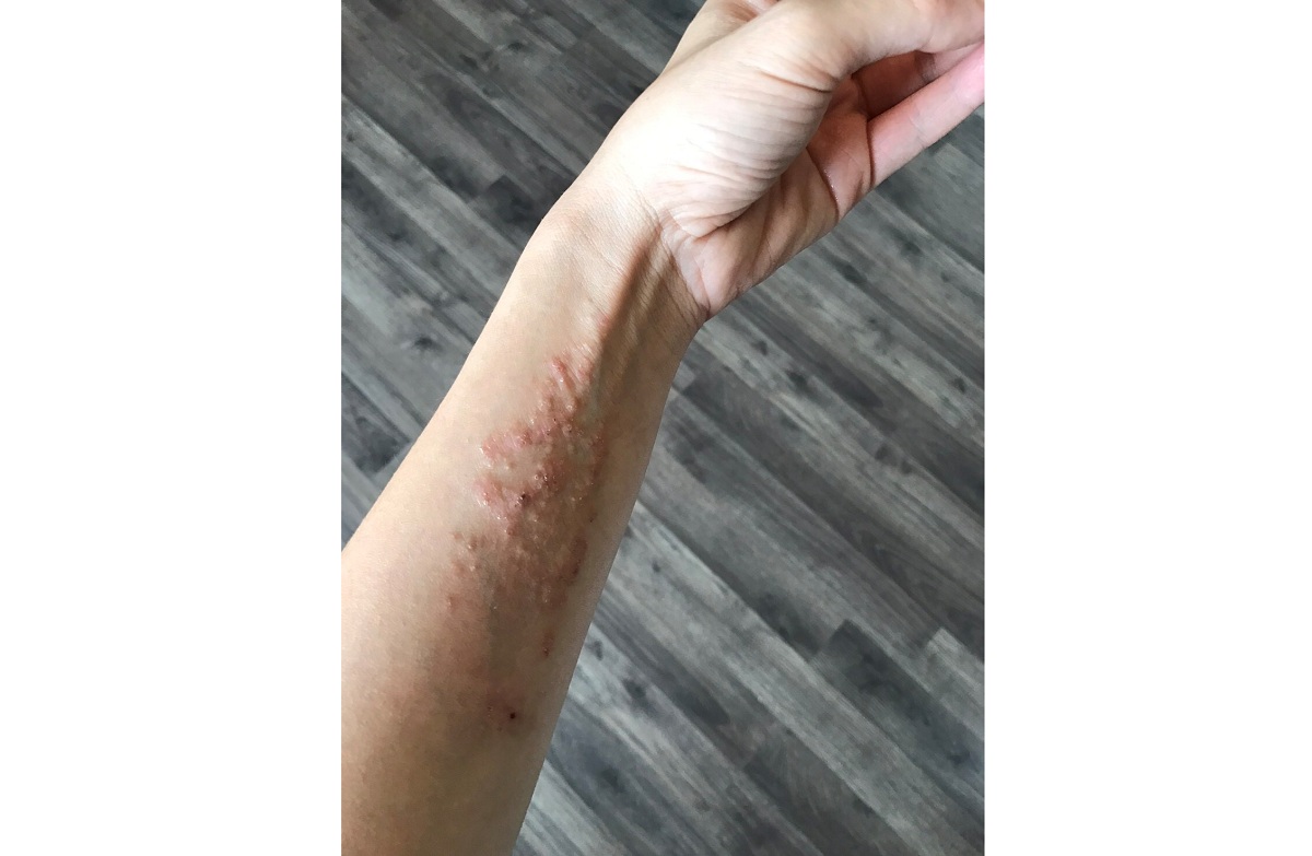 異位性皮膚炎