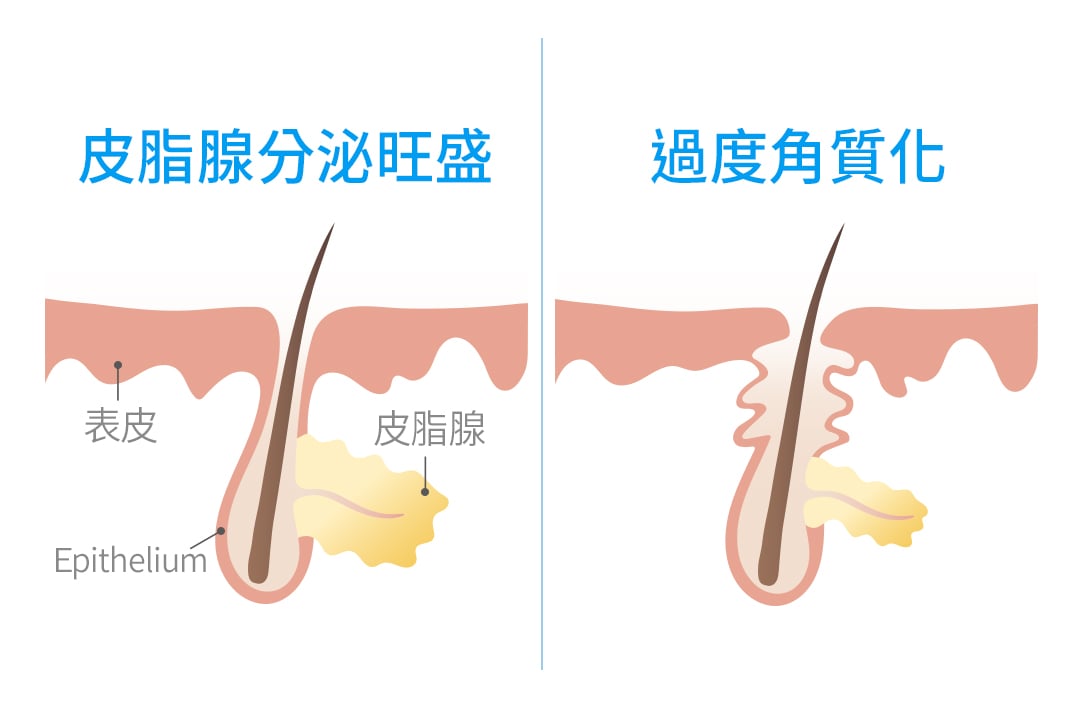 什麼是痘痘肌、粉刺痘痘